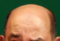 Of hair loss and male libido