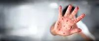 Health Ministry: HFMD cases rise 28 times compared to last year
