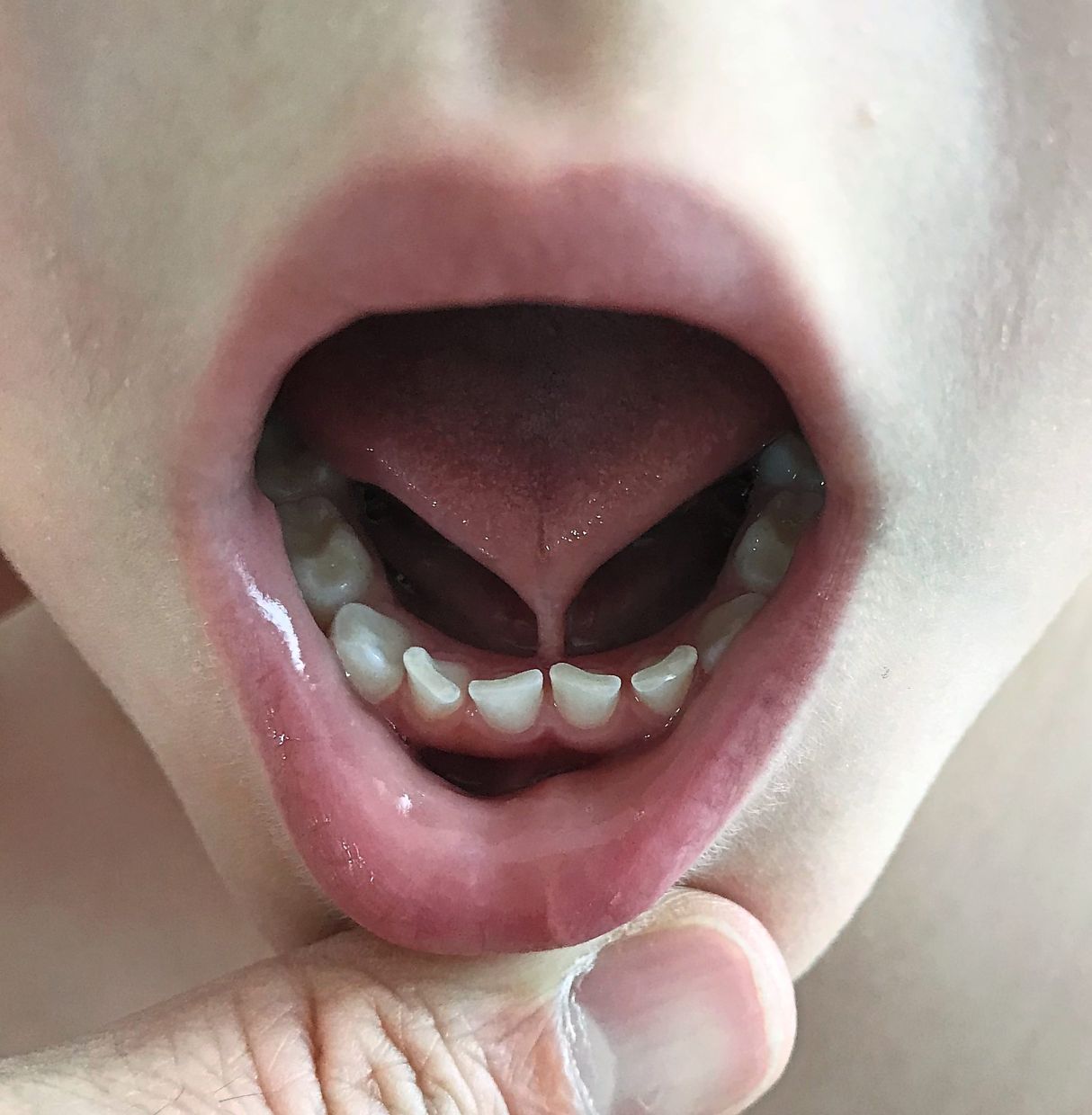 A tongue-tie is one of the factors that can prevent a newborn from breastfeeding well and can cause the mother nipple pain. — Wikimedia Commons