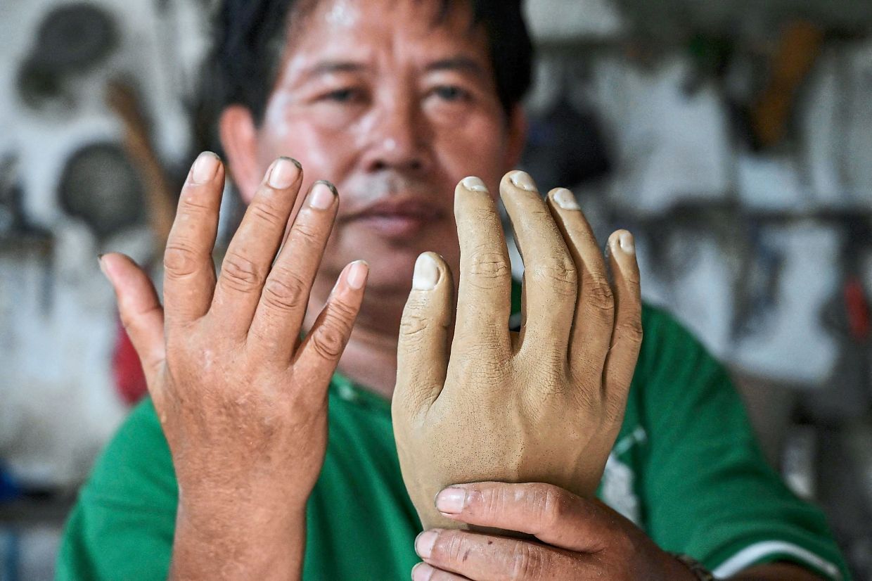 Sculpting a new life for lepers The Star