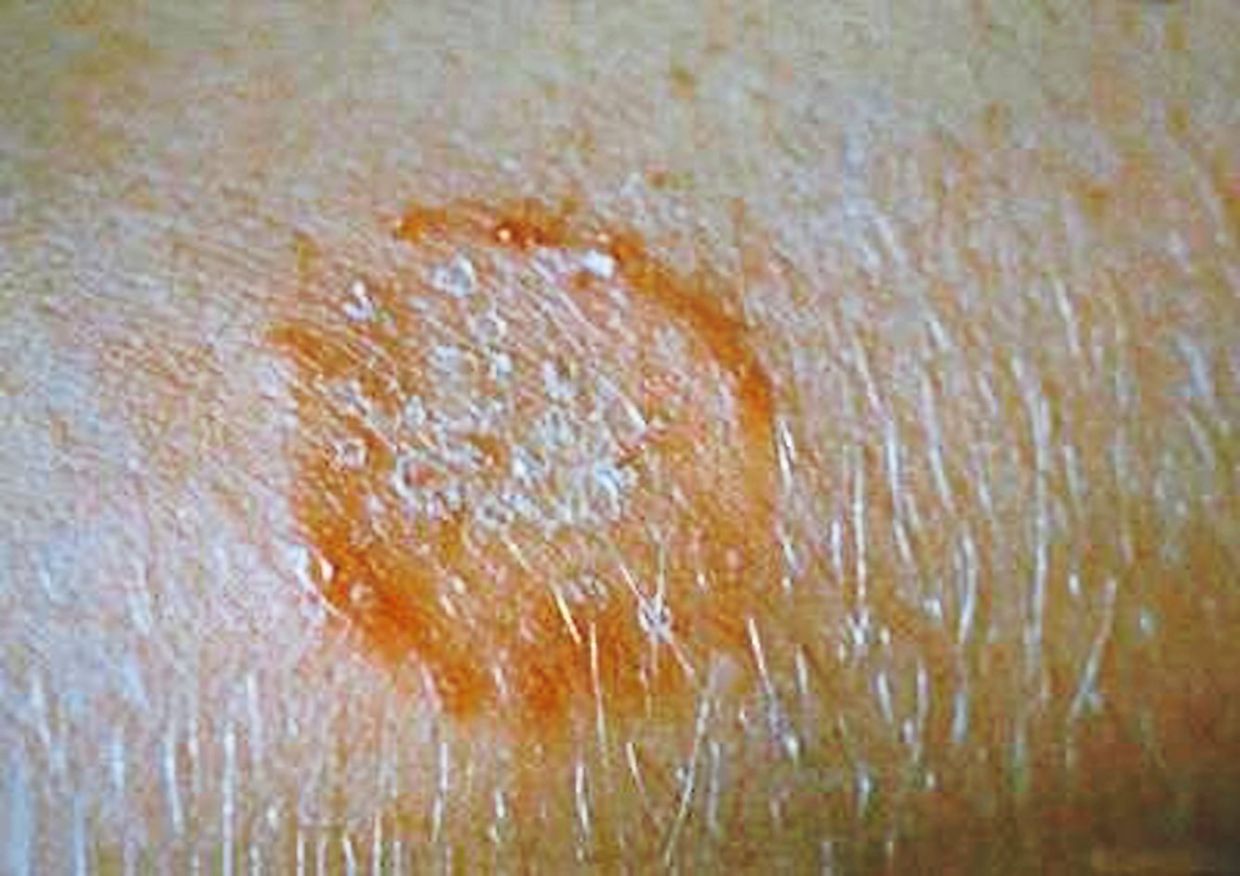 Ringworm is a common fungal infection that doesn't involve worms at all. — SZETOO WEIWEN