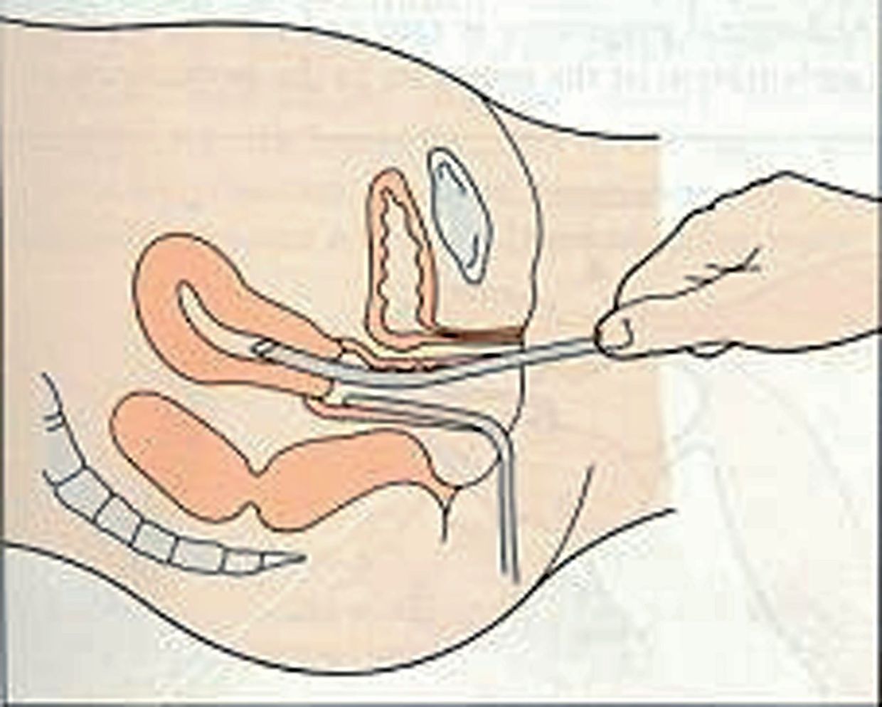Repeated curettage can cause damage to the endometrium that results in it becoming too thin to support the implantation of an embryo.
