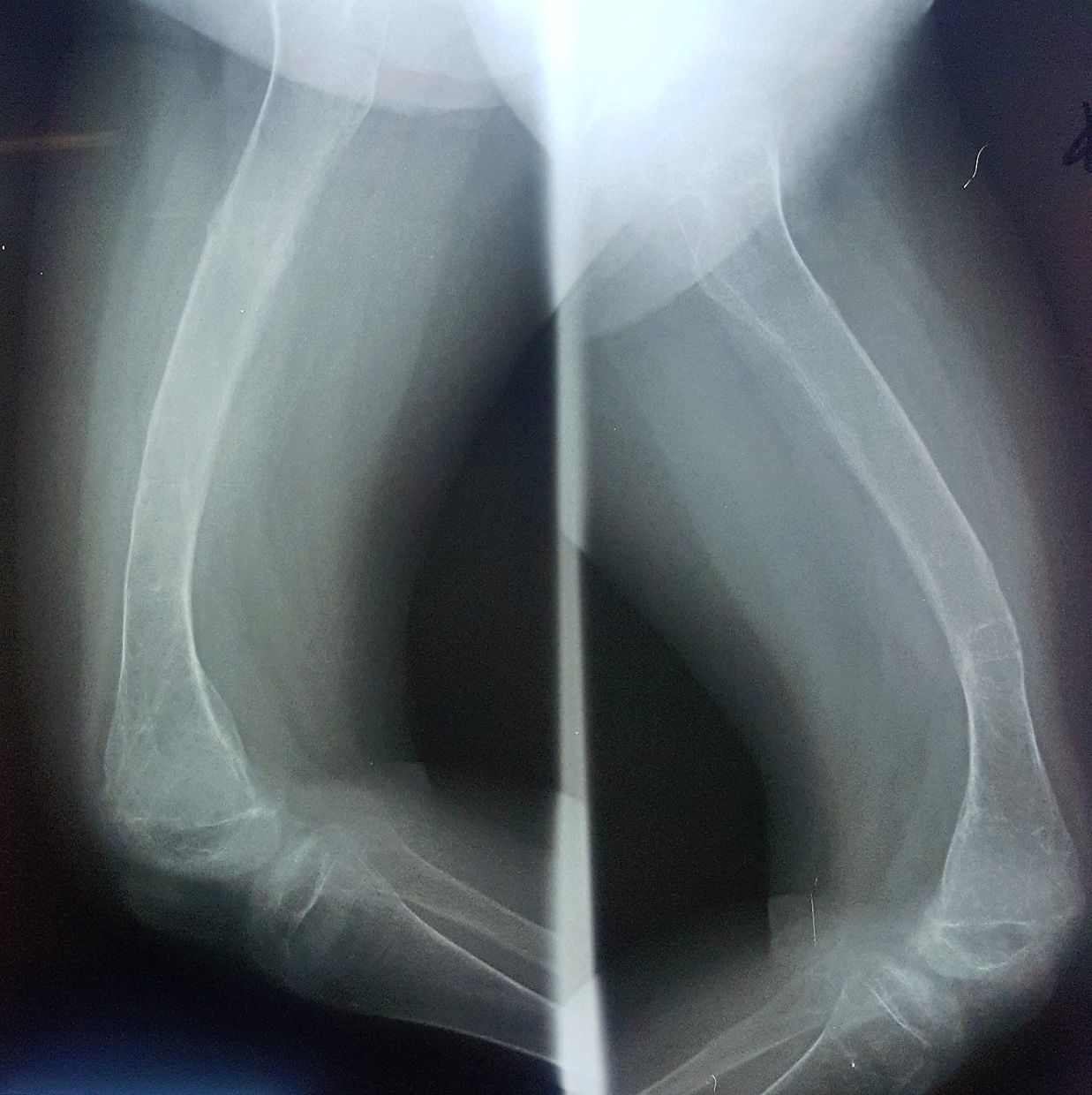 These X-rays show extreme bowing of the leg bones in severe rickets.