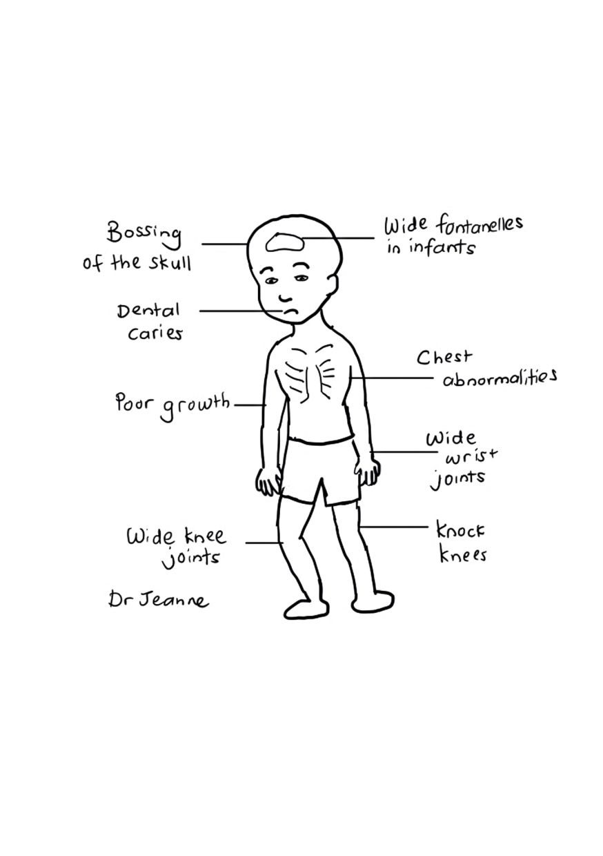 The complications of rickets.