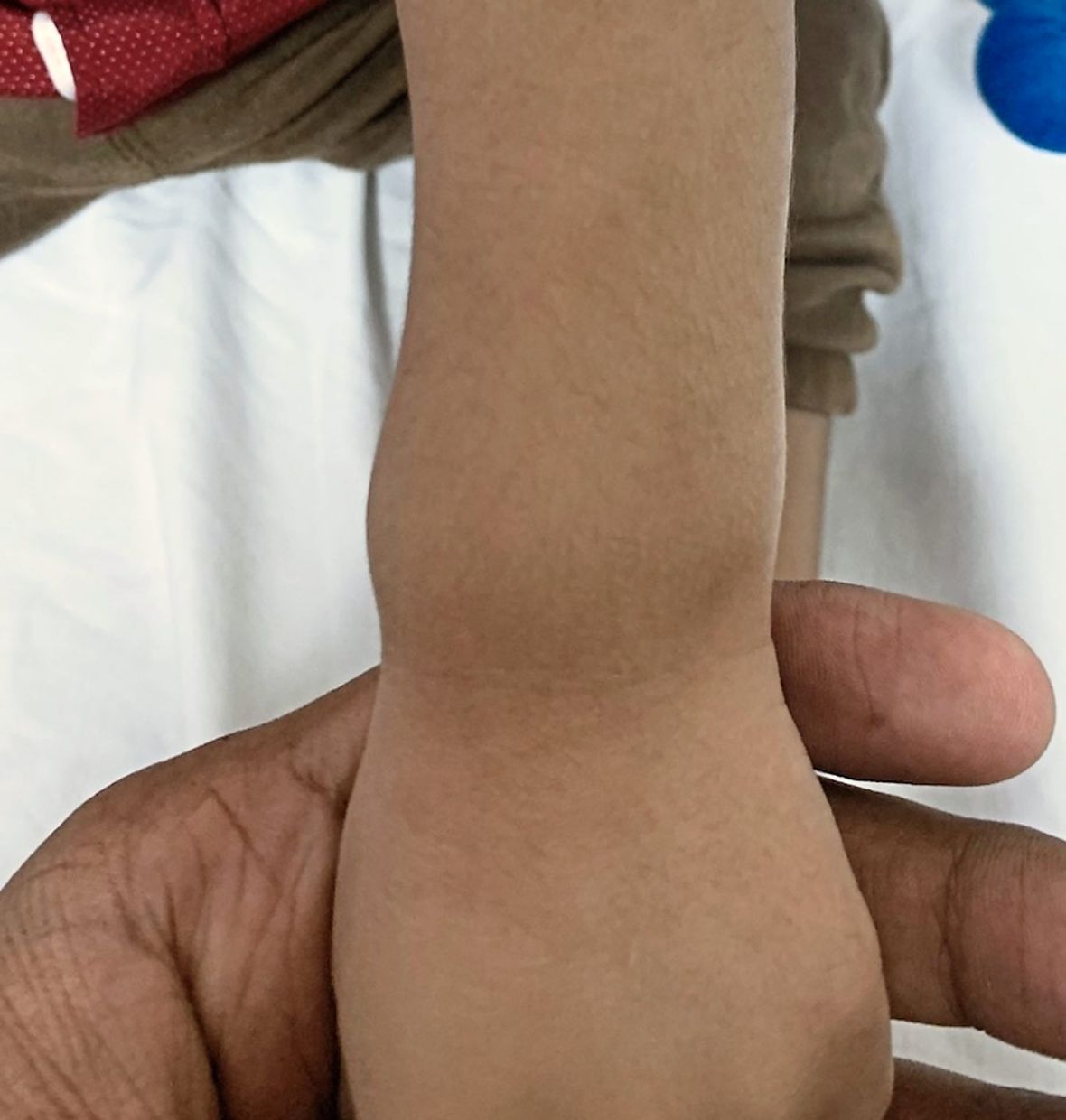 This baby has swelling of the wrist joint – another sign of rickets.