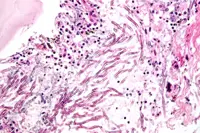Some fungal infections prey on immunocompromised individuals