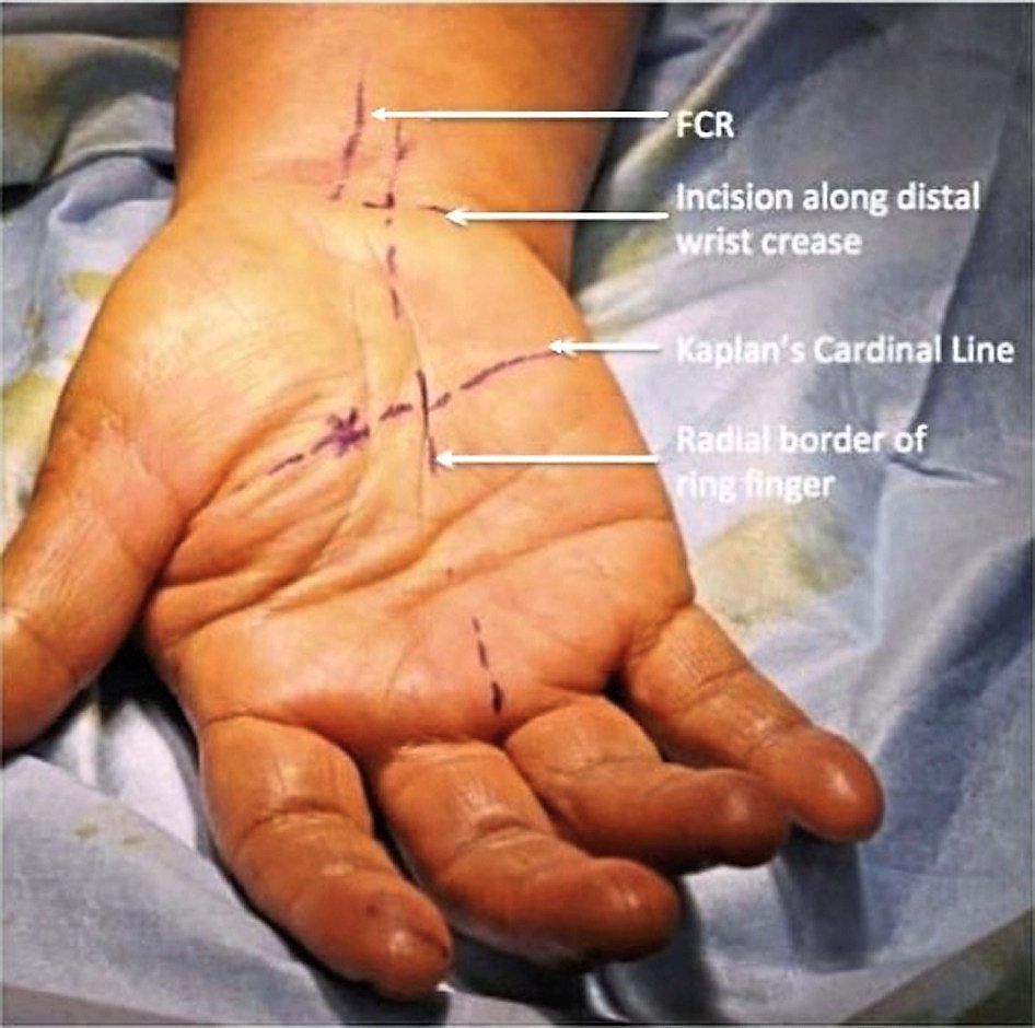 Before every CTS surgery, the surgeon will make these markings on the patient's hand to help guide them during the procedure.