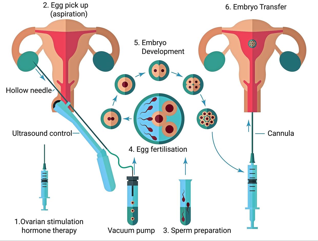 There are various factors that can negatively influence any of the steps in the IVF process, resulting in failure of the procedure. — Positive Parenting