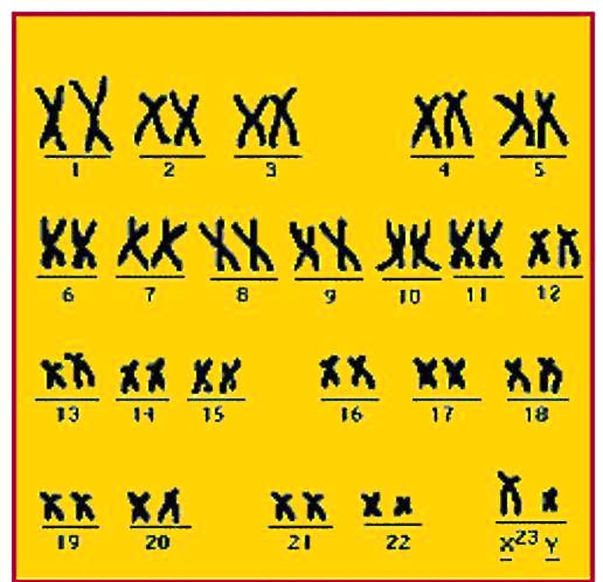 The SRY gene on the Y sex chromosome is the main gene influencing how a fetus’ gonads develop.