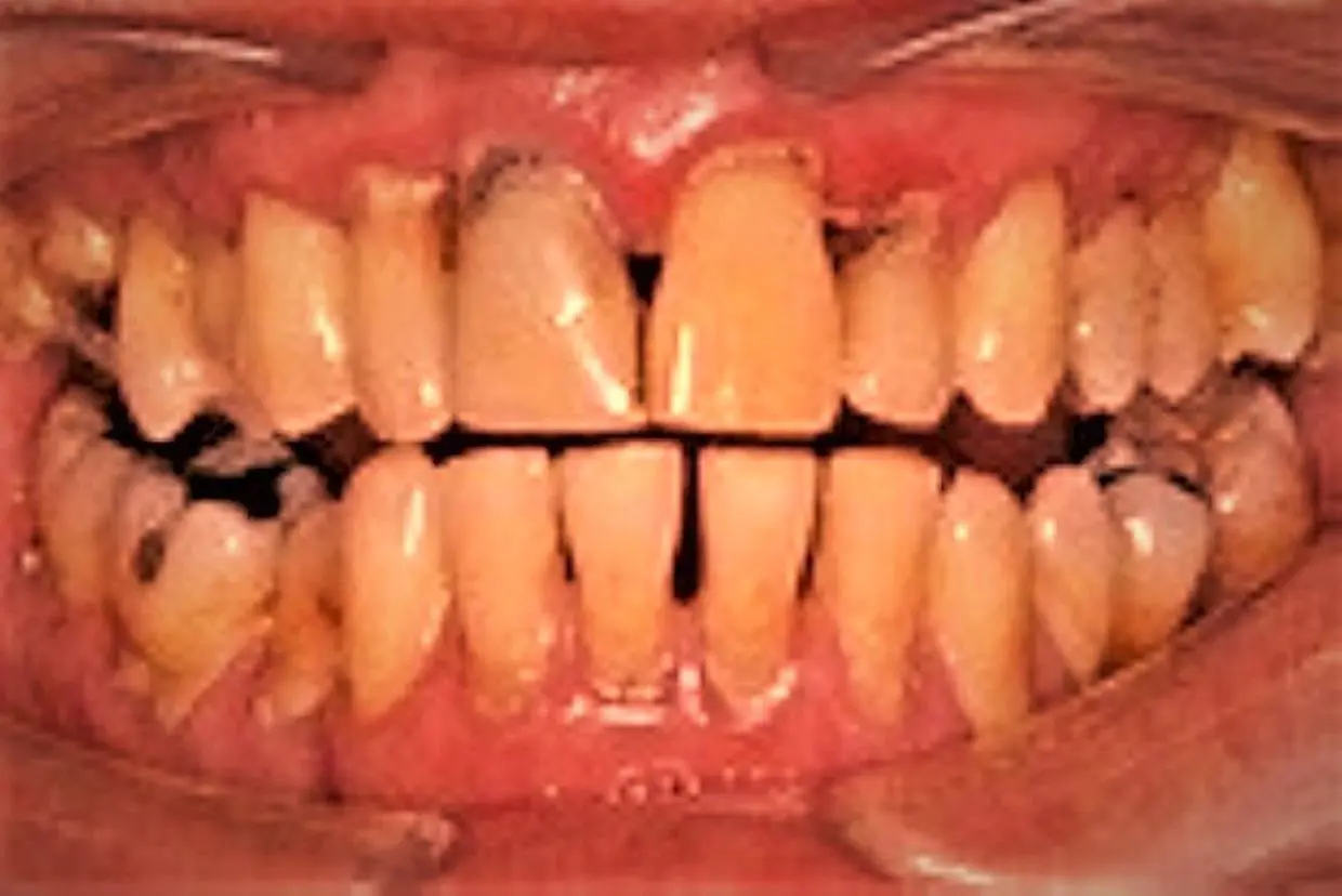 cigarette gum disease Beware! Smoking masks the signs of gum disease until it gets serious