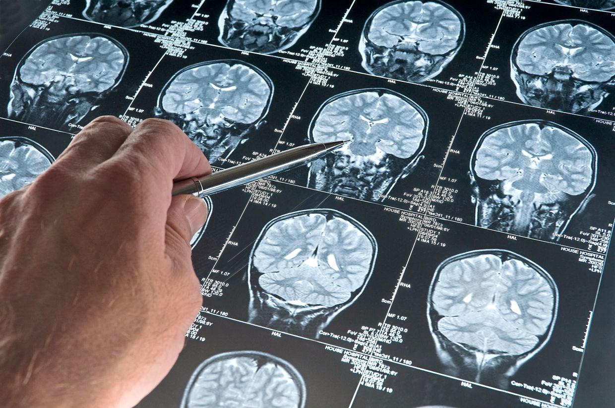 A potential breakthrough in detecting Parkinson's disease - Vimarsana News
