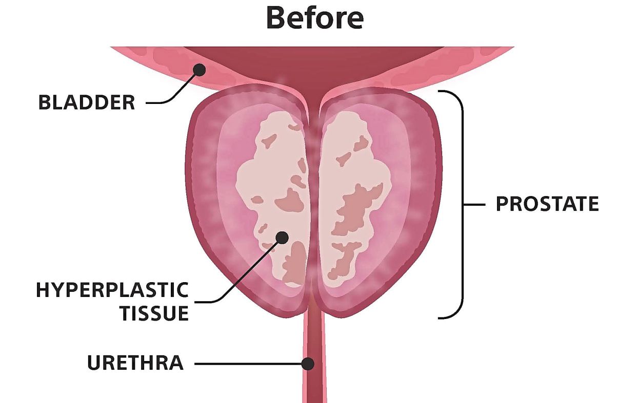 An image of an enlarged prostate, often known as benign prostatic hyperplasia (BPH).