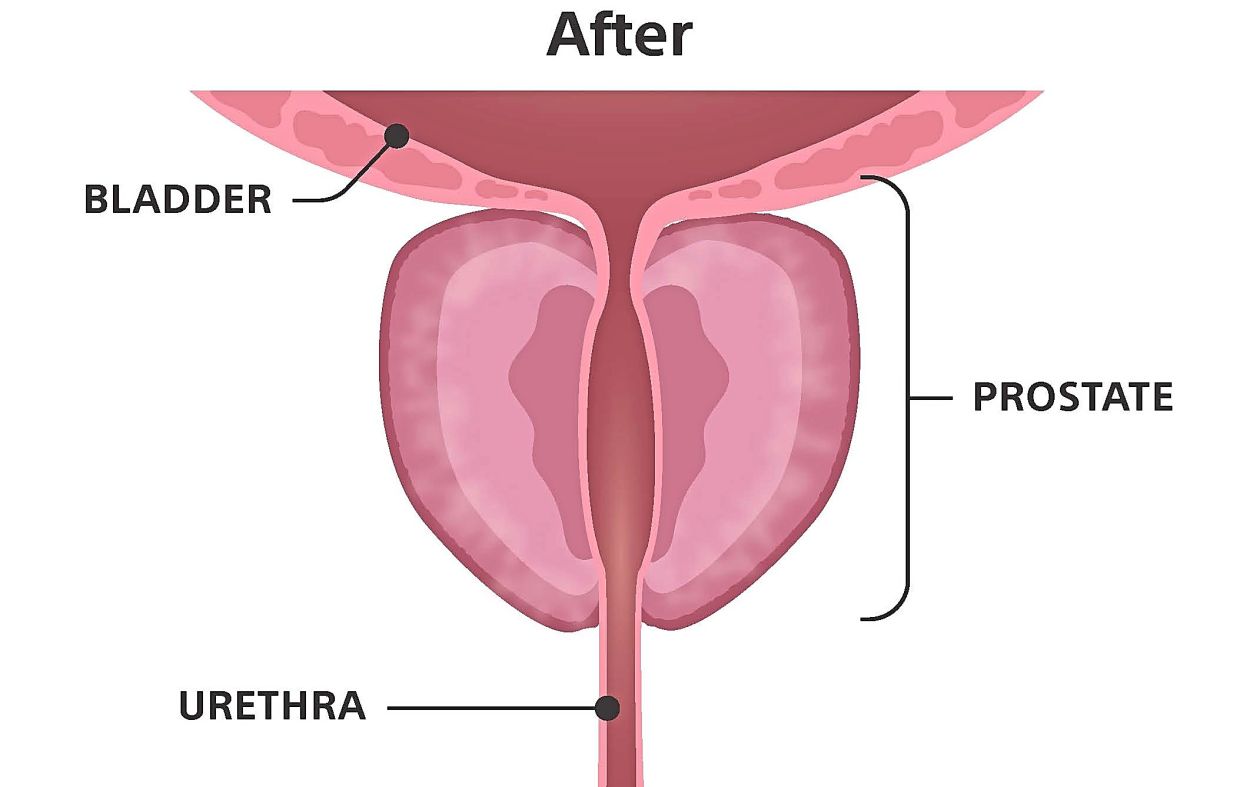 The image after water vapour therapy.
