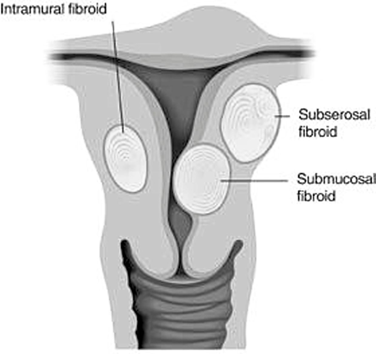 Drugs now available to treat uterine fibroids The Star