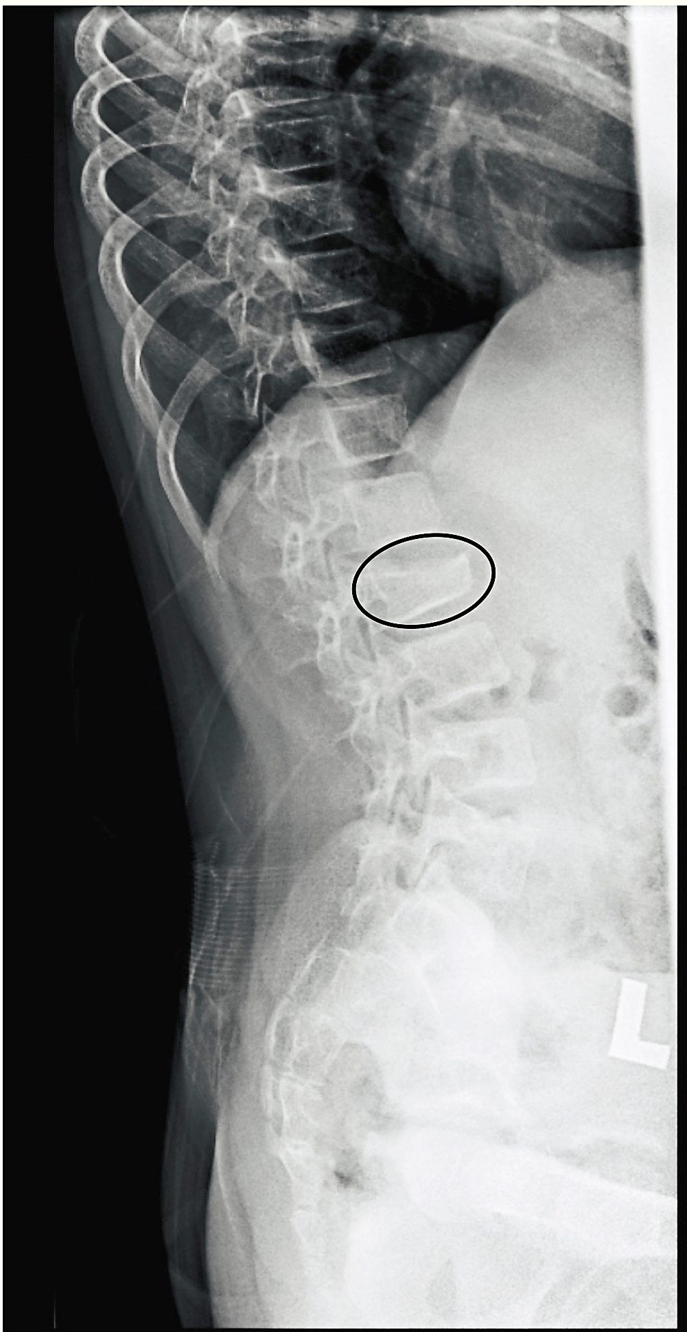 This X-ray of a child with osteoporosis shows a compression fracture of the vertebrae body resulting in a wedge-shaped appearance (circled).