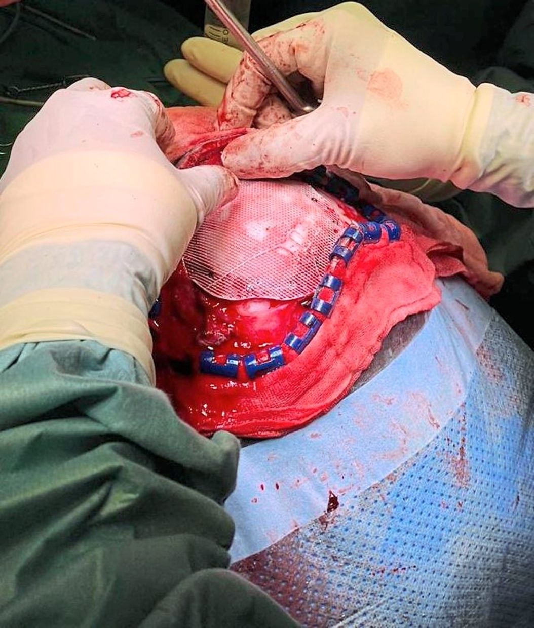 Here, Dr Sharon is performing a cranioplasty on a 12-year-old patient, using 3D printed biomaterial scaffolds. — Dr SHARON CASILDA THEOPHILUS