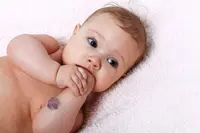 That red birthmark on your baby could be a (harmless) tumour