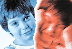 This type of bipolar patient often appears outwardly normal