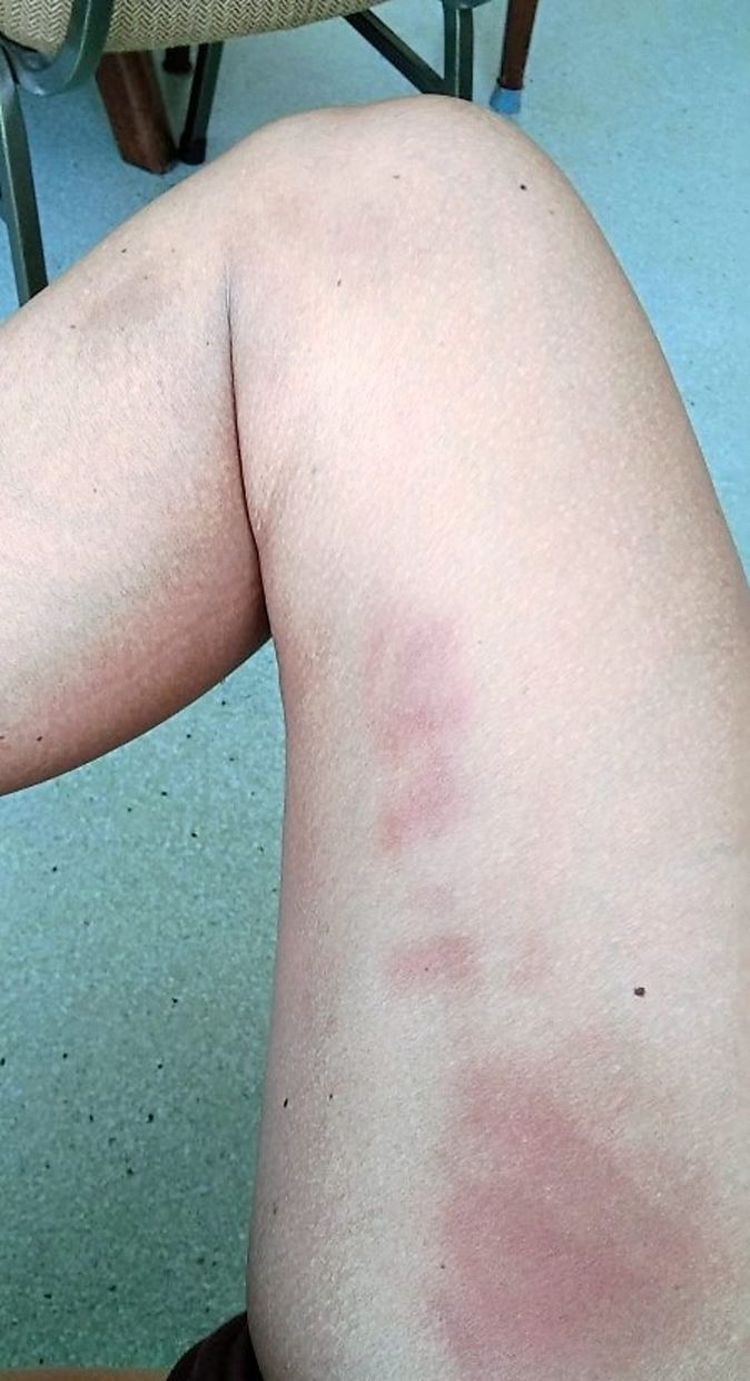 The bruises that appeared along the vein of the writer’s right thigh, which were never definitively diagnosed.