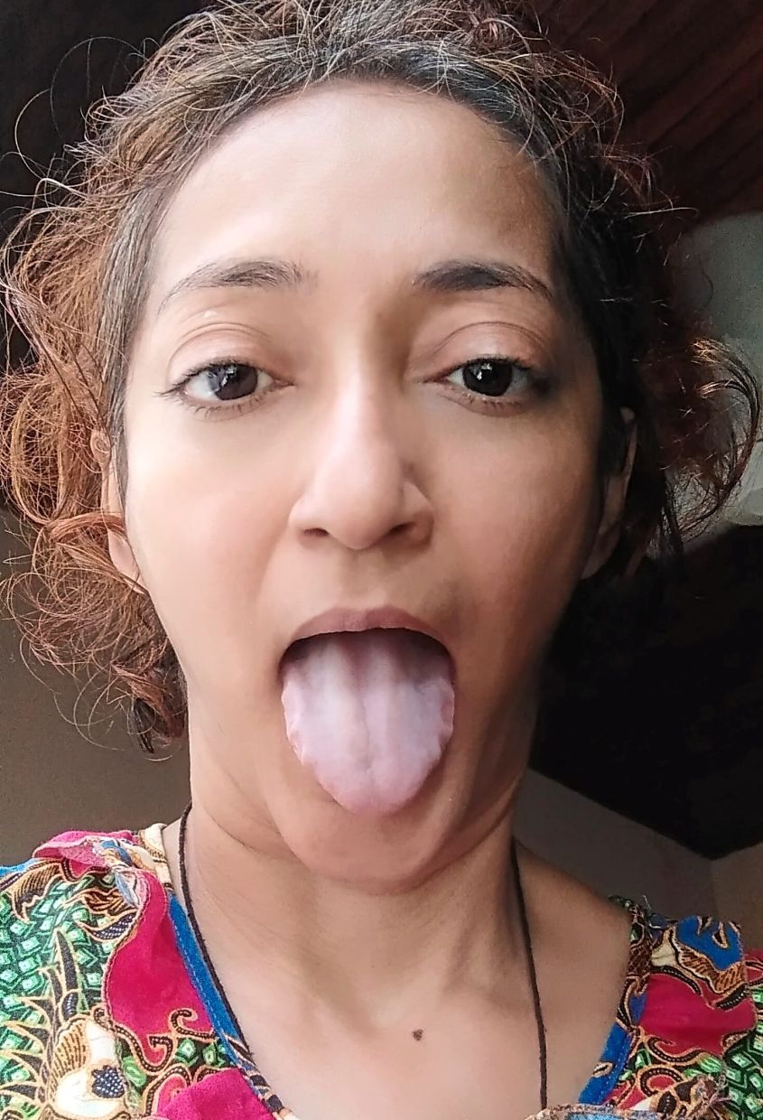 The writer shows her coated, swollen tongue (note the teeth marks) – an indication of dehydration and digestive issues – during her second Covid-19 infection.