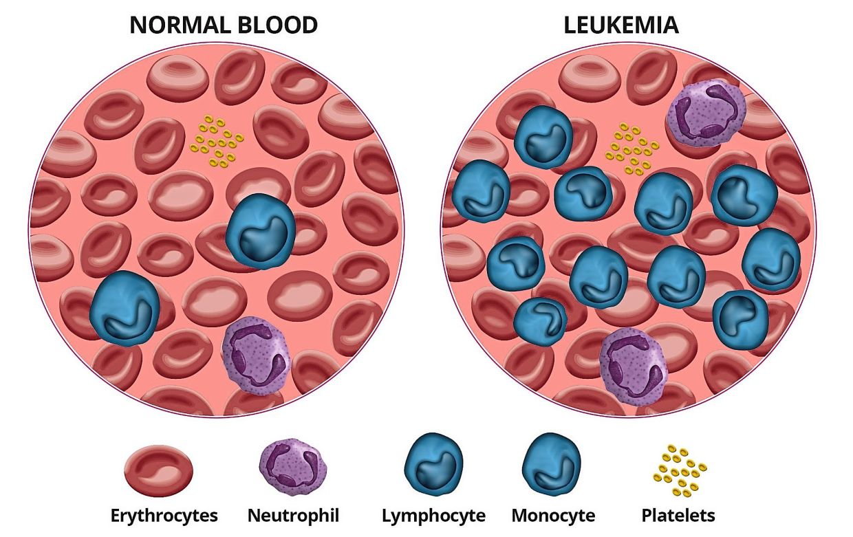 Looi has chronic myeloid leukaemia, a cancer of the white blood cells. — Filepic