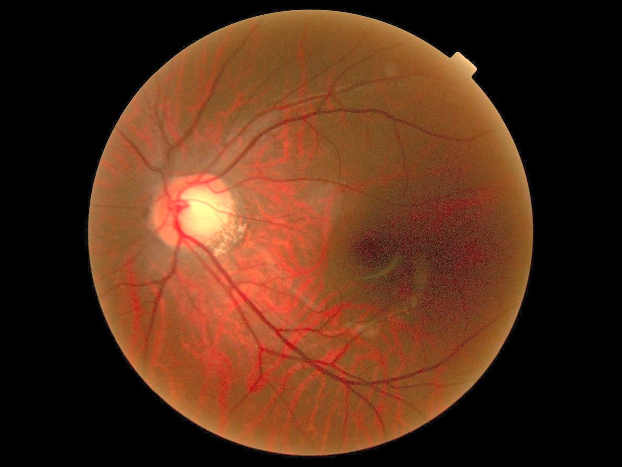 Glaucoma can be diagnosed via a gonioscopy, measuring the pressure in the eye or assessing the field of vision. — Filepic