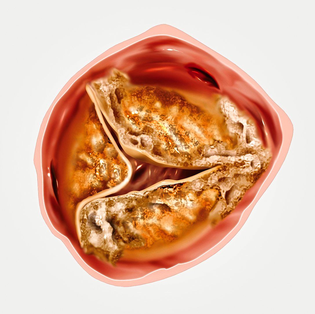 A stenotic aortic valve is narrowed and reduces blood flow out of the heart. — Images: Handout