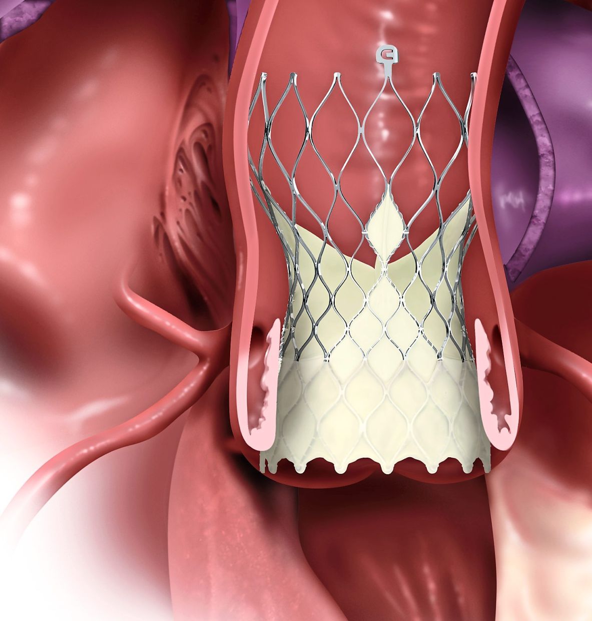 TAVR is a minimally invasive procedure to replace a narrowed aortic valve that fails to open properly.
