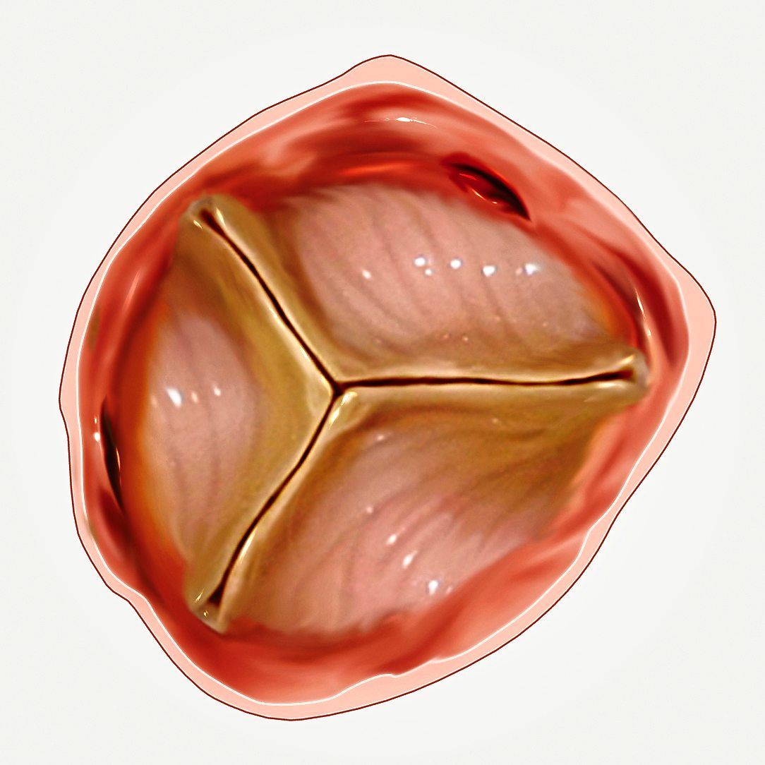 A normal aortic valve should look like this and opens every time your heart contracts. Images: Handout