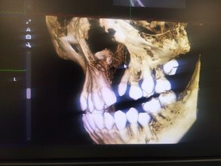 Cone Beam Computed Tomography (CBCT) imaging is extremely valuable for the diagnosis and management of CLP because it provides better information about the appearance and size of the anatomic structures affected by the cleft.
