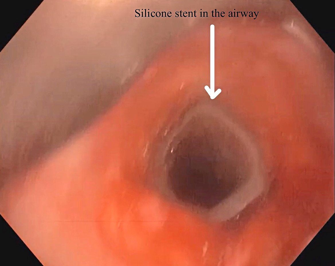 Here's a silicon stent that has been inserted to widen the airway.