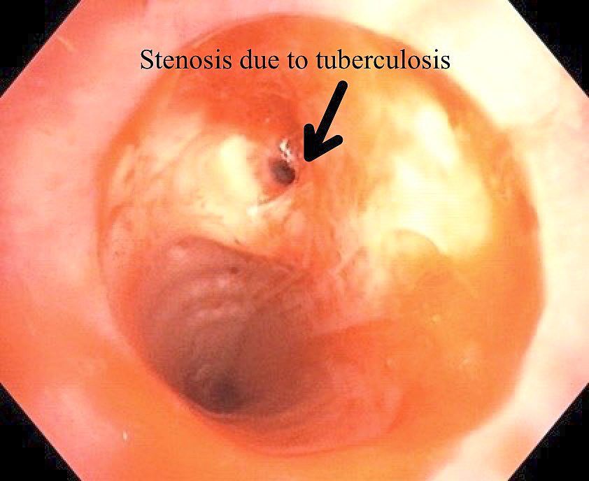 This patient has severe stenosis, or narrowing, in one of their airways due to tuberculosis. — Photos: Dr JAMALUL AZIZI ABDUL RAHAMAN