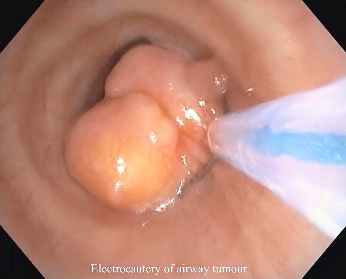 These large tumours that obstruct the airway can mostly be removed with IP.