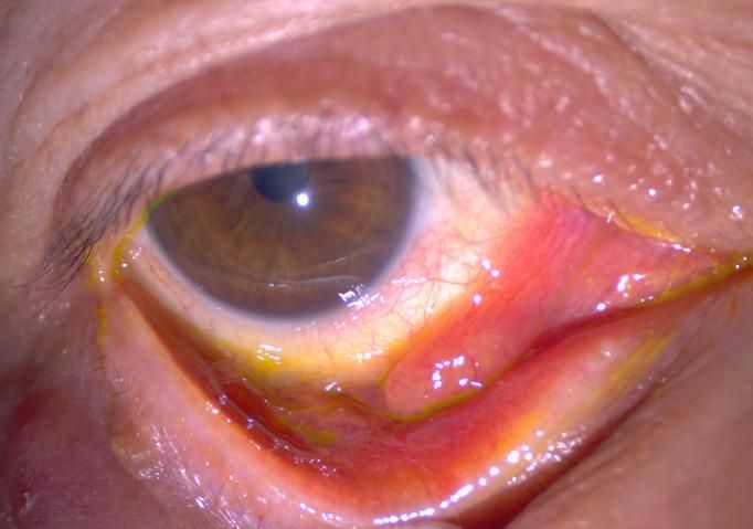 This patient came to the clinic complaining of prolonged red eyes and swelling. On examination through the camera, the doctor found a growth (granulomatous tissue) at the lower eyelid, which was caused by cat scratch disease. — Dr ADRI SHAFIT