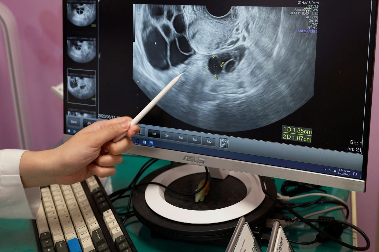 Hope for female cancer patients to preserve fertility through Ovarian Tissue Cryopreservation at Sunfert - Vimarsana News