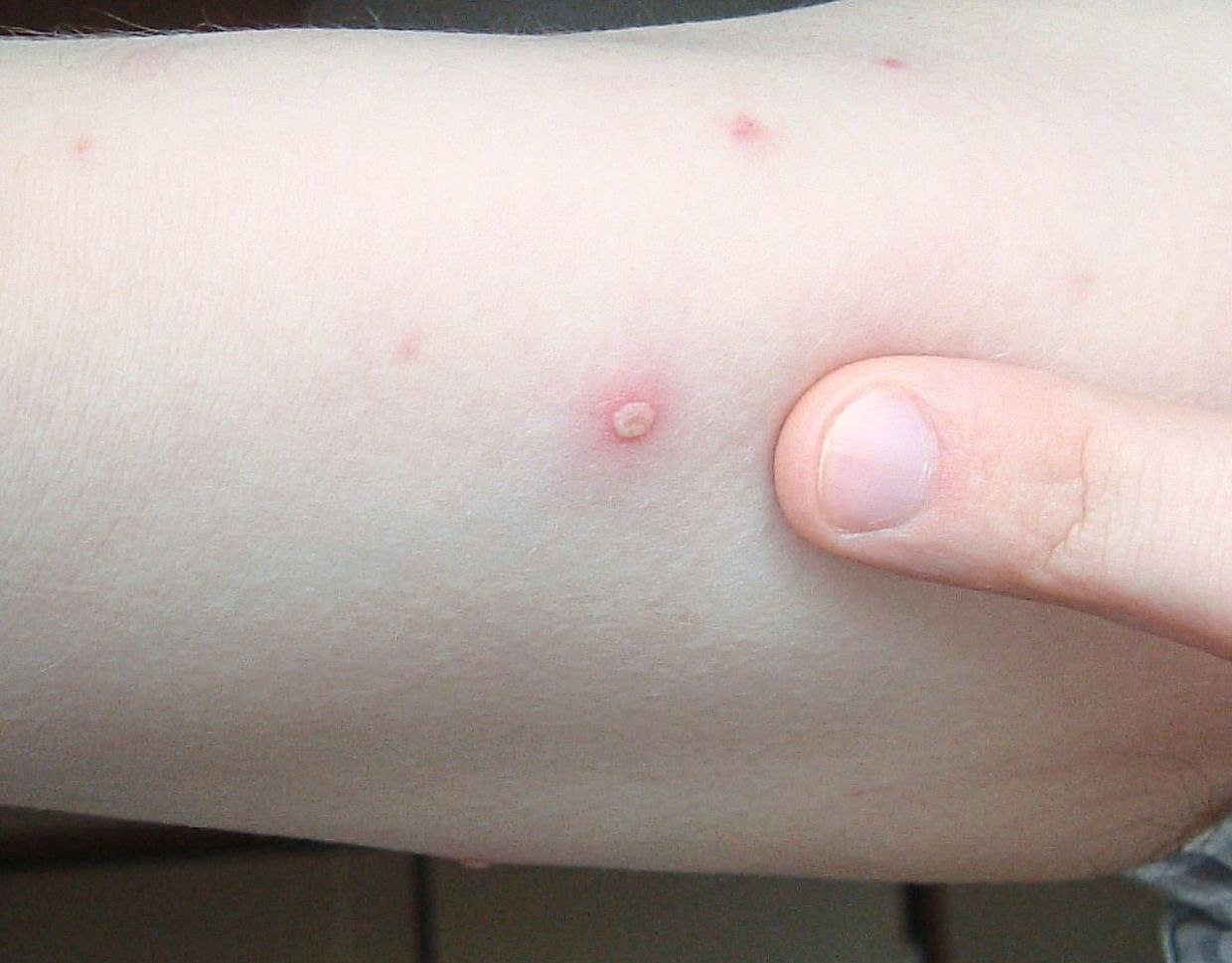 While measles produces flat, red, blotchy rashes (as seen in the photo above), chickenpox starts with raised red spots that become fluid-filled blisters.