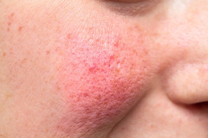 Rosacea is a skin vascular lesion that can be removed using yellow lasers.