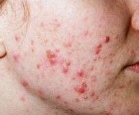 Ablative lasers are used for skin-resurfacing treatments, which includes removing the scars left by acne.