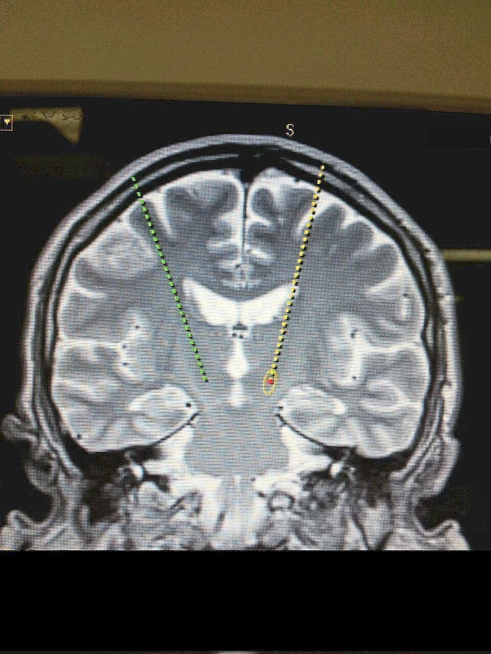 An MRI of a Parkinson's patient's brain, with selected targets for electrode placement and the entry trajectory for deep brain stimulation – one of the surgical options to manage the disease. — Filepic
