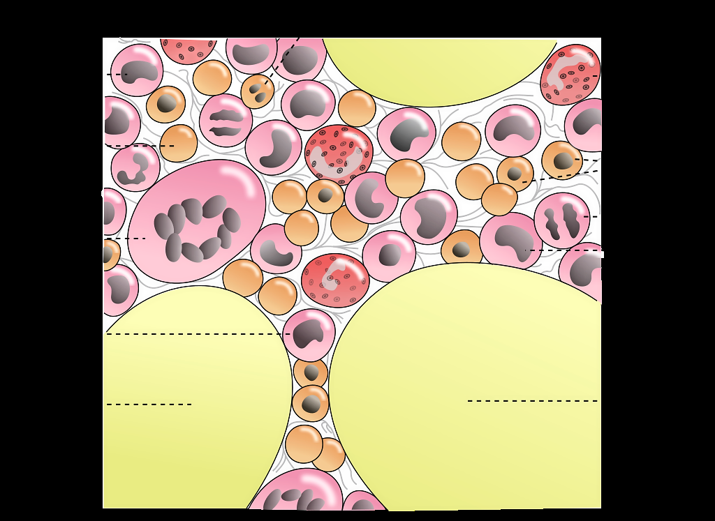 Aplastic anaemia causes your blood cell production to go down - Vimarsana News