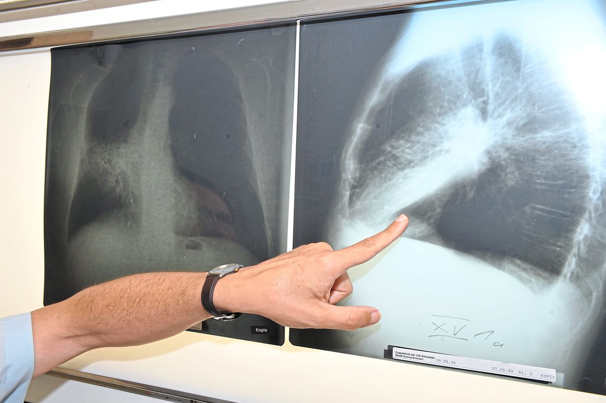 Potential one-step diagnosis and treatment for early lung cancer - Vimarsana News