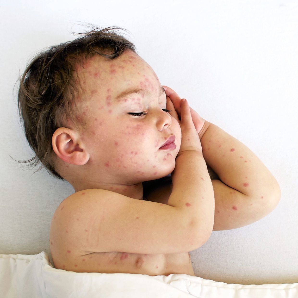 Chickenpox is not just another rash | The Star