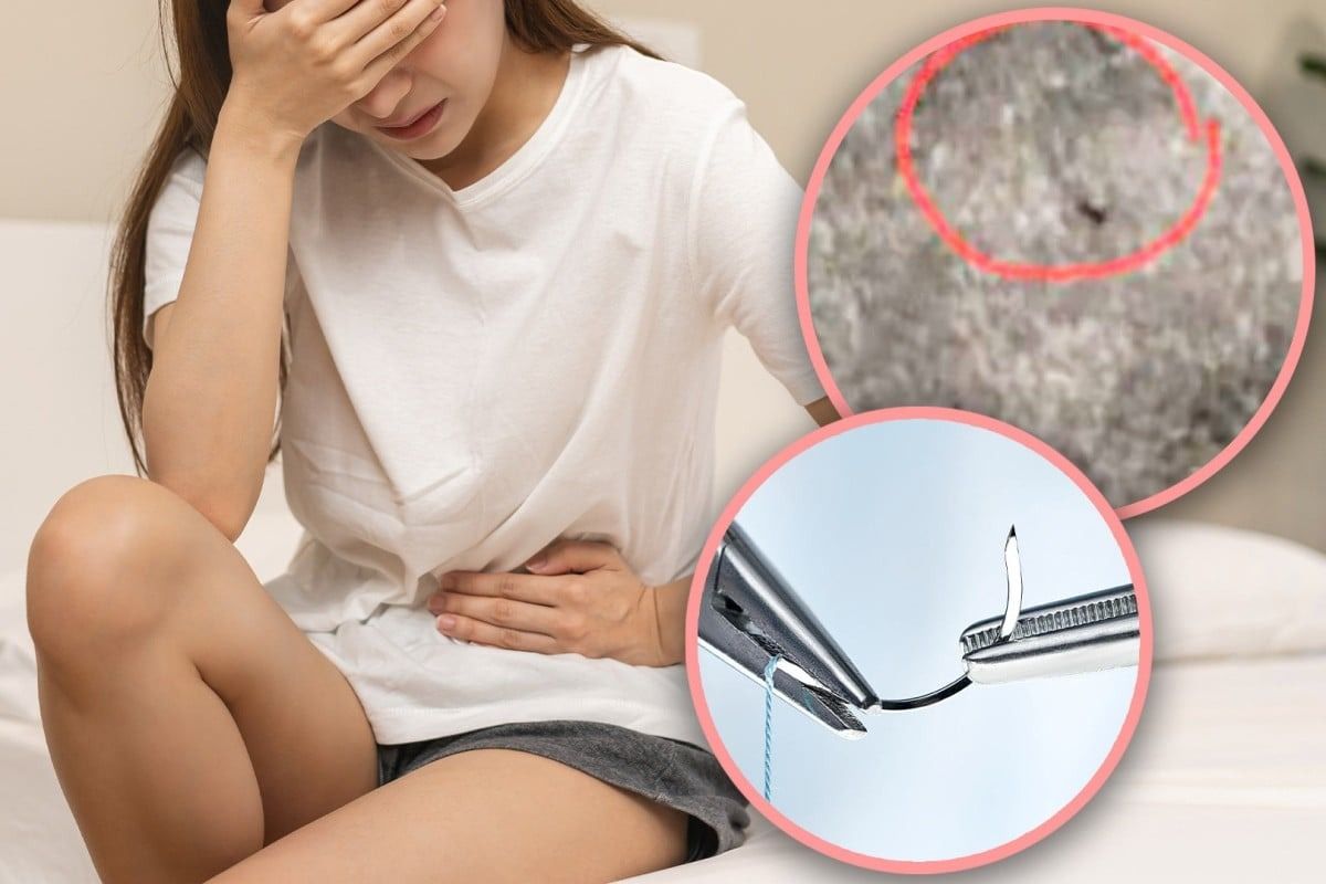 Thai woman suffers 18 years of pain after childbirth, finds needle left ...