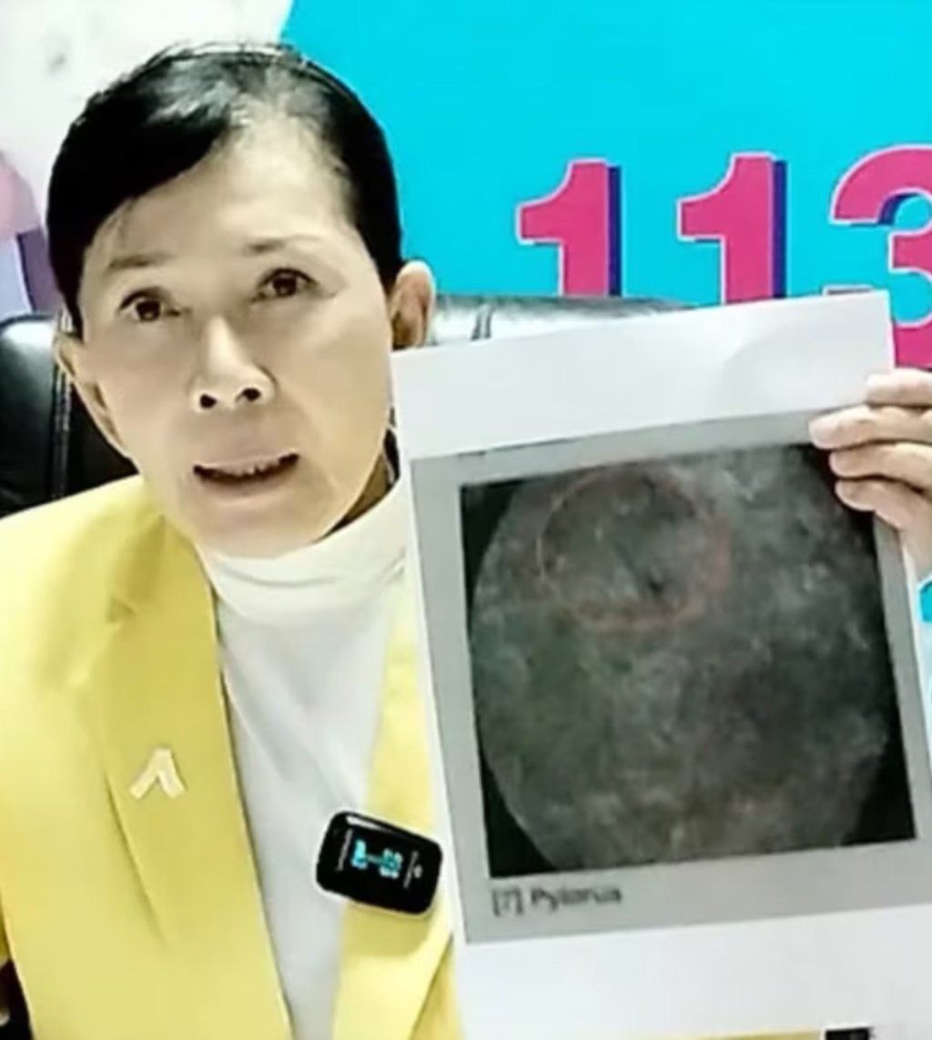 A representative from a pro-women NGO in Thailand is holding an X-ray film that clearly displays the needle lodged in the woman’s vagina, highlighting the urgent need for support and medical attention. - Pavena Foundation for Children and Women