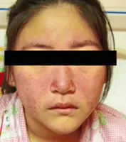 Children can also get systemic lupus erythematosus (SLE)
