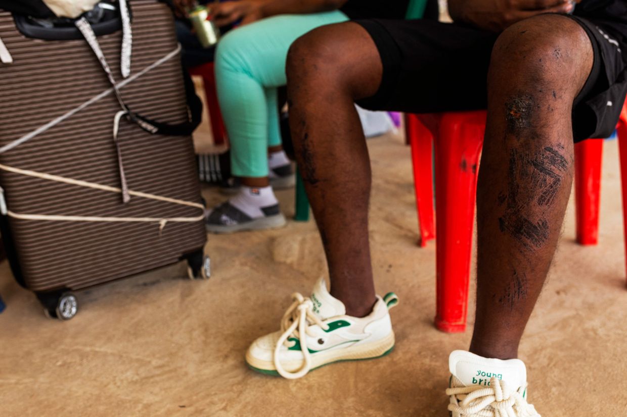 An alleged victim of a scam centre showing the injuries on his legs as he waits with other survivors to cross the border to Thailand to be repatriated, in Kyauk Khet in Myanmar's Myawaddy township on Feb 12, 2025. - AFP
