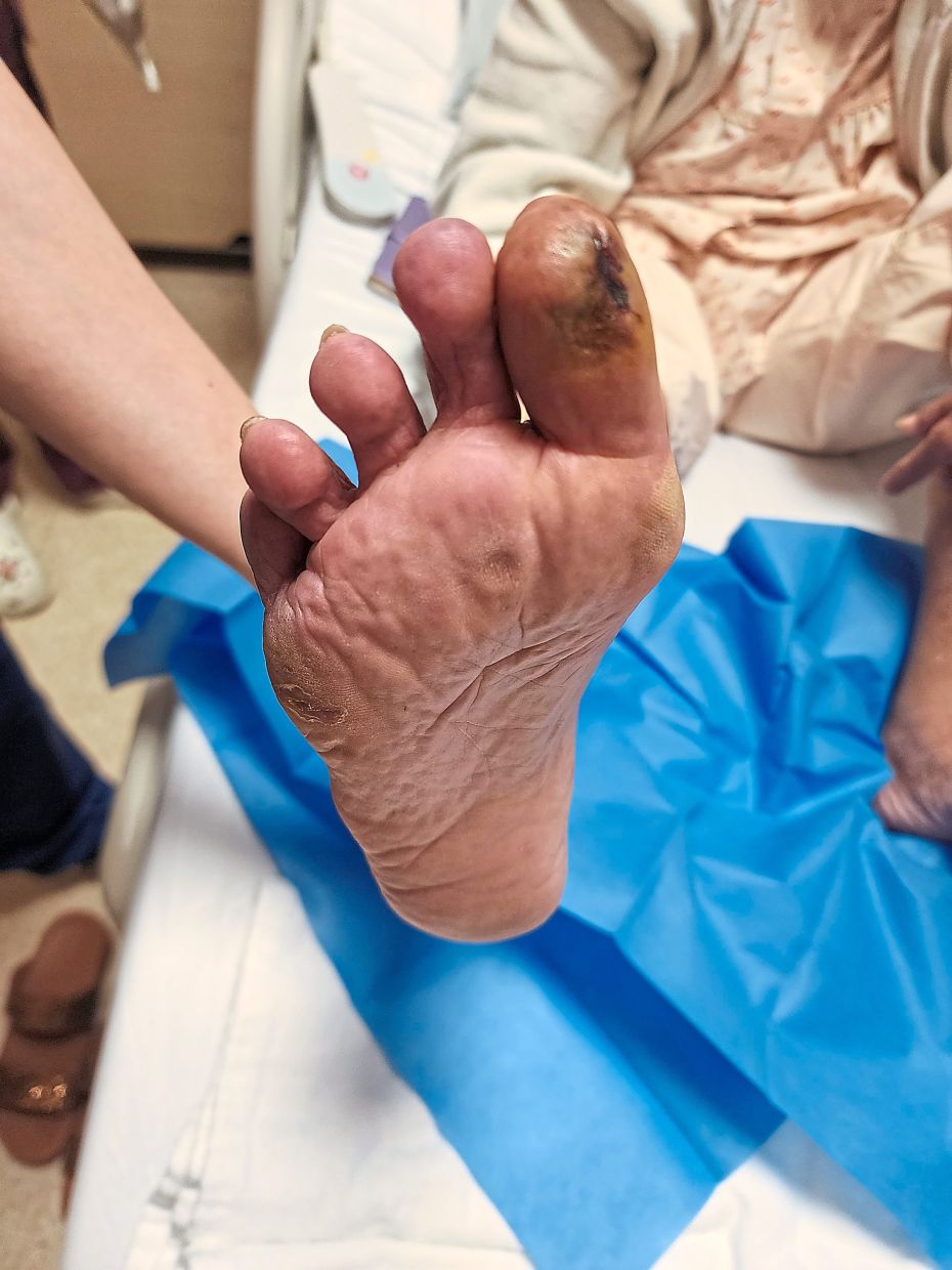 The tissue in this diabetic patient’s toe was in the process of dying and turning black (gangrenous) due to lack of blood supply from a blocked artery in the leg.