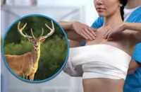 Breast implants with cattle DNA leave woman in China severly disabled