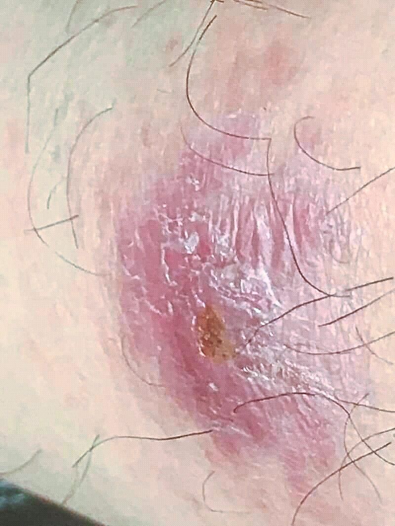 Lichen sclerosus causes the affected skin to thin and lose elasticity, making it fragile and prone to tearing. — Wikimedia Commons