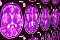 The two types of brain aneurysms